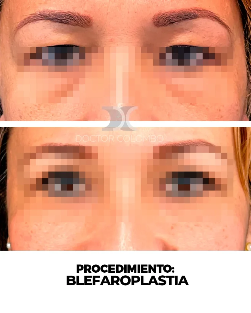 BLEFAROPLASTIA EN PARPADO SUPERIOR – BAJO ANESTESIA LOCAL — Perfil derecho