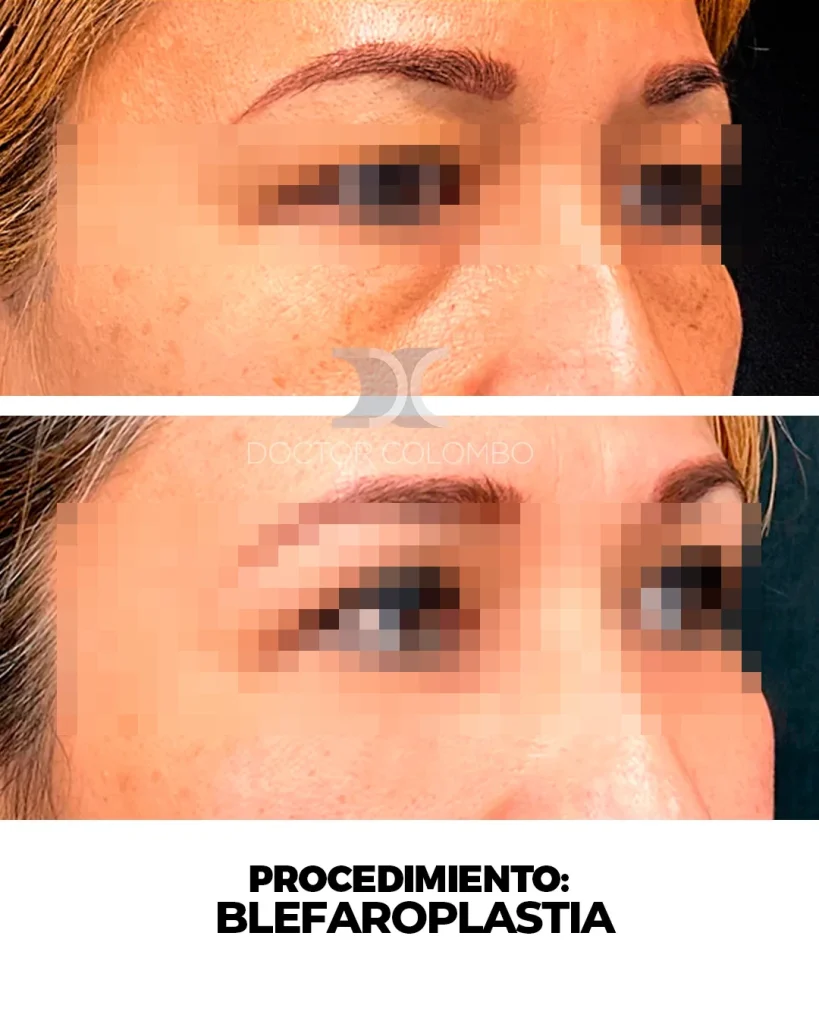 BLEFAROPLASTIA EN PARPADO SUPERIOR – BAJO ANESTESIA LOCAL — Perfil izquierdo