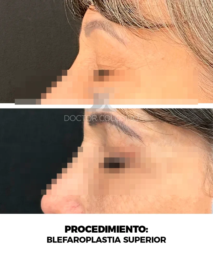 BLEFAROPLASTIA SUPERIOR E INFERIOR TRANSCONJUNTIVAL + MICROFAT GRAFTING EN PARPADO INFERIOR — Perfil izquierdo