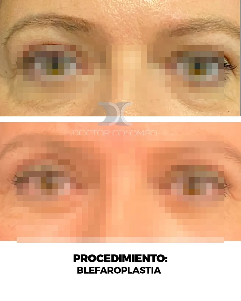 BLEFAROPLASTIA EN PARPADO SUPERIOR E INFERIOR + NANOFAT PERIORBITARIO – CON ANESTESIA LOCAL – AMBULATORIO — Frontal