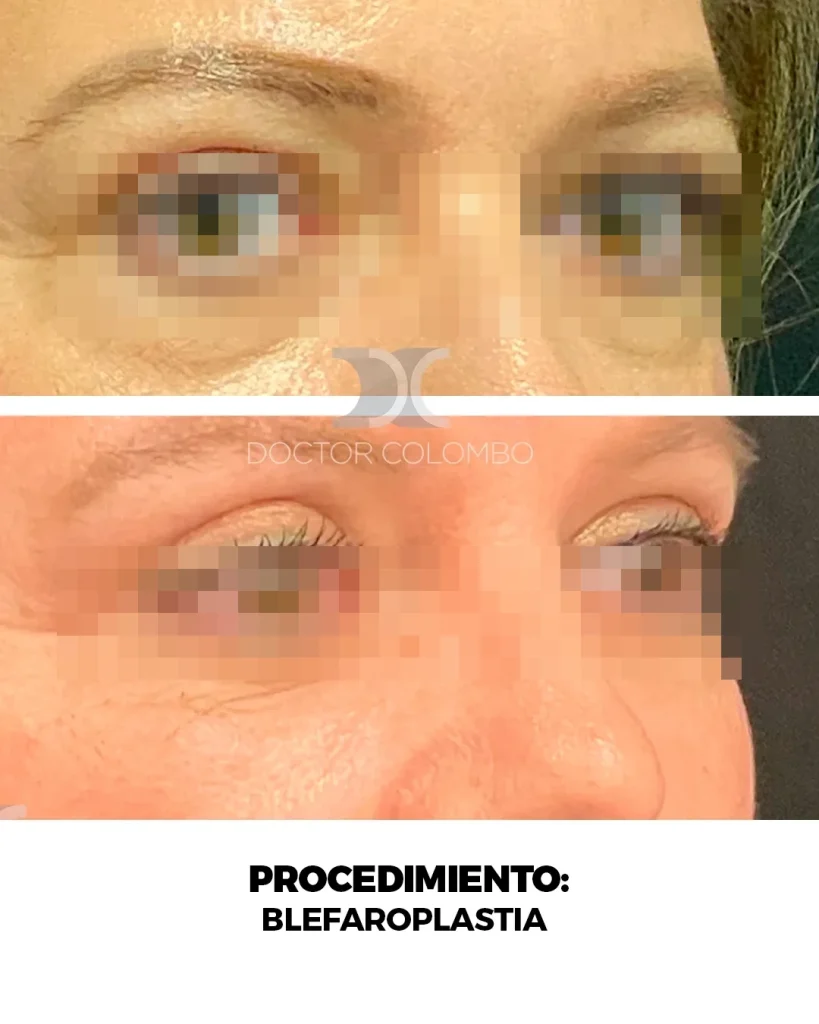 BLEFAROPLASTIA EN PARPADO SUPERIOR E INFERIOR + NANOFAT PERIORBITARIO – CON ANESTESIA LOCAL – AMBULATORIO — Perfil derecho