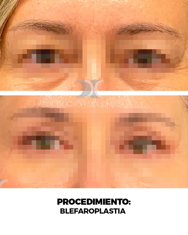 Antes y después de Blefaroplastia