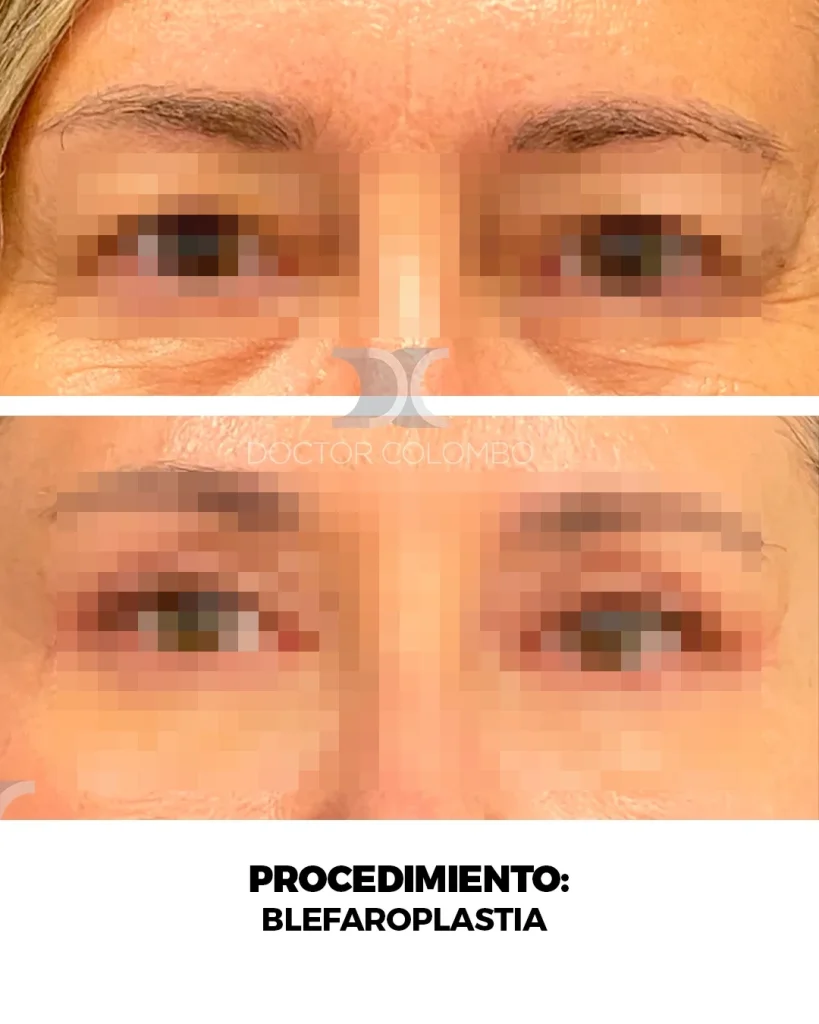 BLEFAROPLASTIA EN PARPADO SUPERIOR + LIPOFILLING – FULL FACE FAT TRANSFER  – CON ANESTESIA LOCAL – AMBULATORIO — Frontal