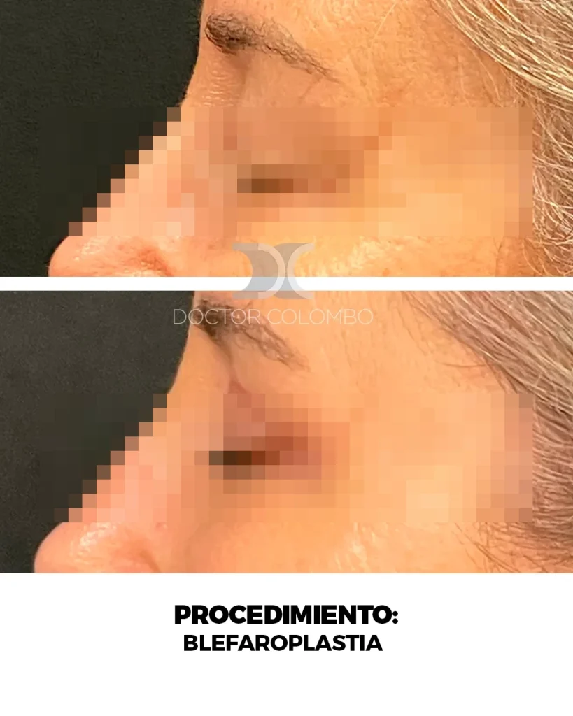 BLEFAROPLASTIA EN PARPADO SUPERIOR + LIPOFILLING – FULL FACE FAT TRANSFER  – CON ANESTESIA LOCAL – AMBULATORIO — Perfil izquierdo