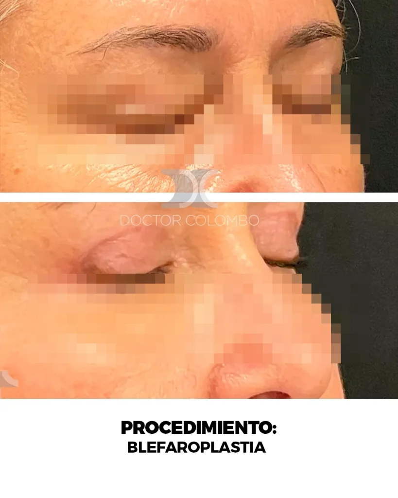 BLEFAROPLASTIA EN PARPADO SUPERIOR + LIPOFILLING – FULL FACE FAT TRANSFER  – CON ANESTESIA LOCAL – AMBULATORIO — Perfil derecho