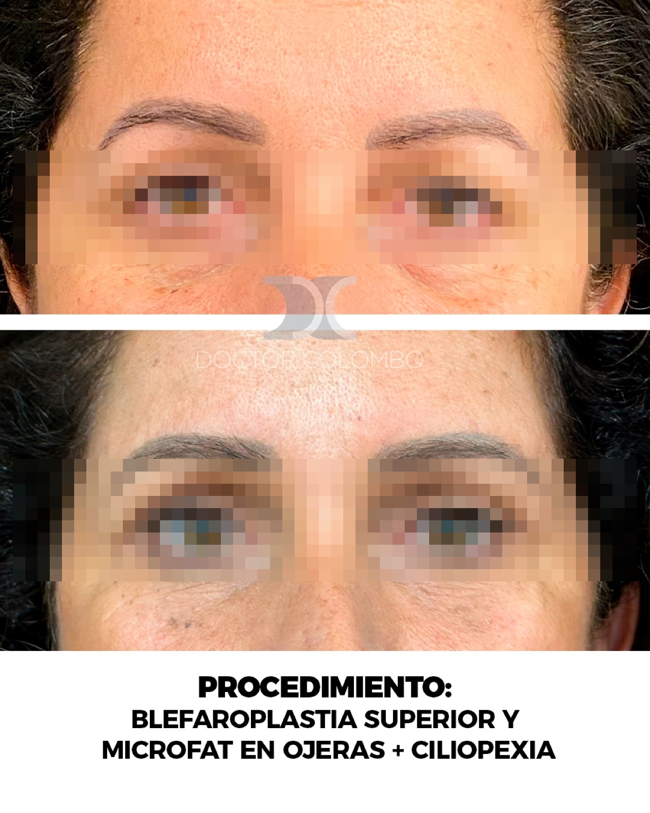 Ciliopexia - antes y después, vista frontal