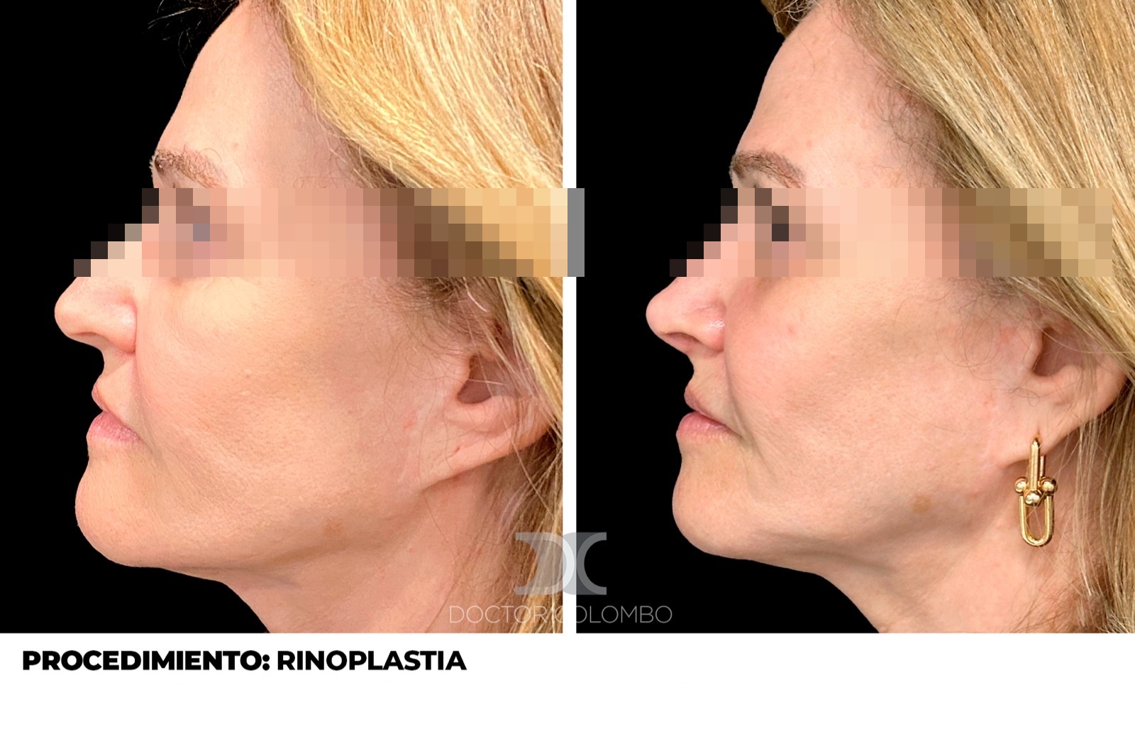 Gibectomía - antes y después, vista de perfil