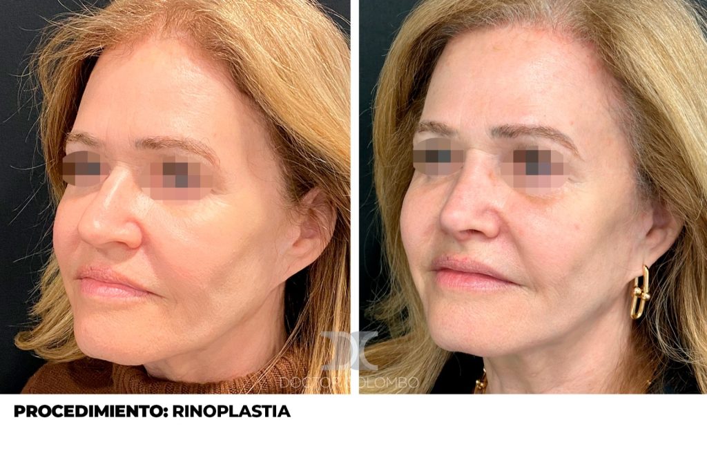 RINOPLASTIA — Perfil izquierdo