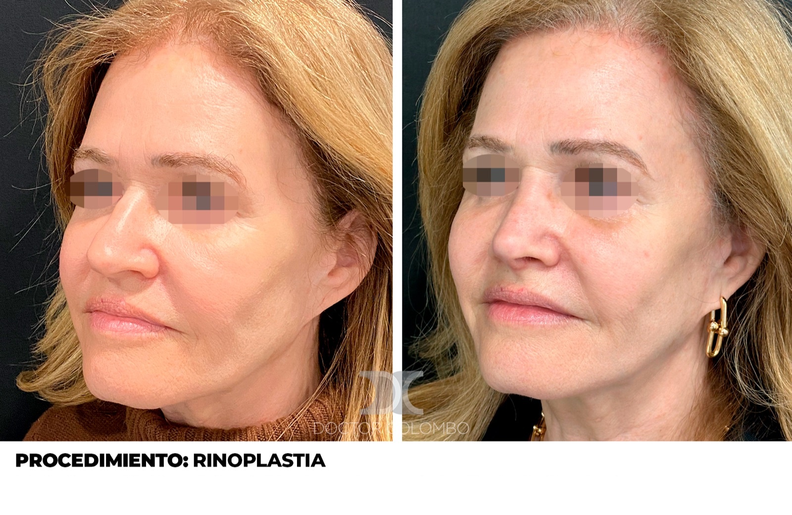 Gibectomía - antes y después, vista de tres cuartos