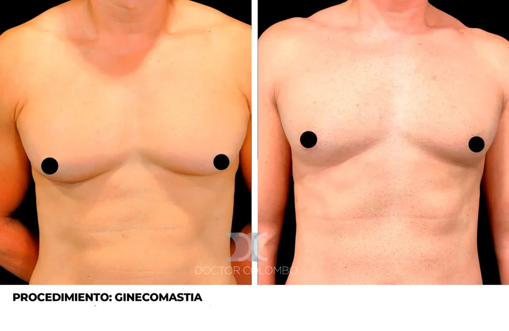 GINECOMASTIA — Perfil derecho
