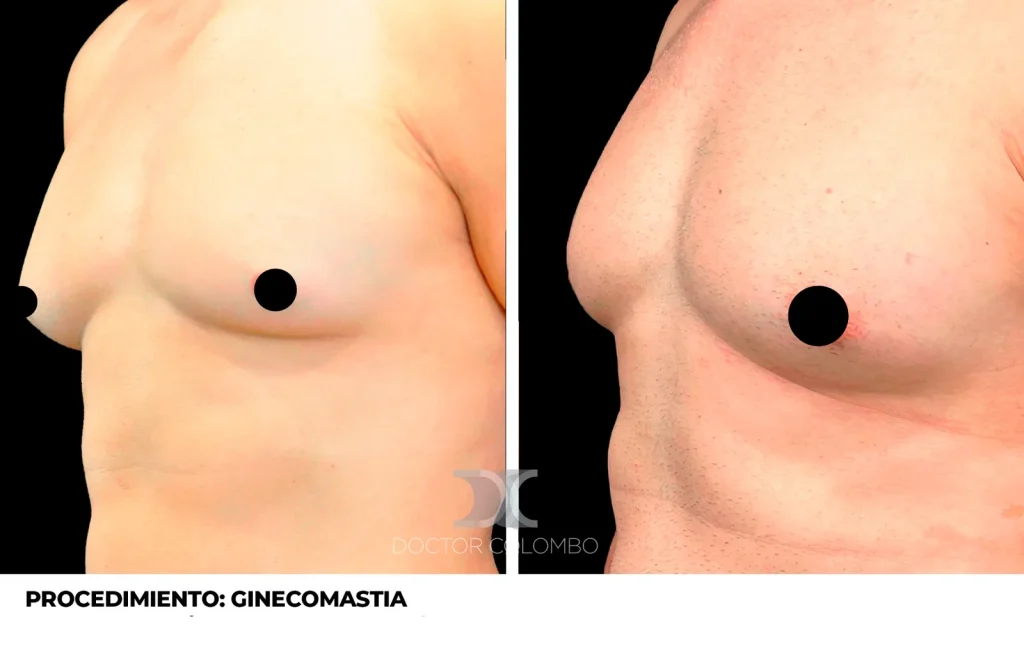 GINECOMASTIA — Perfil izquierdo