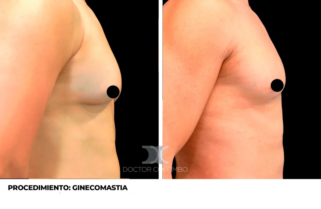GINECOMASTIA — Frontal