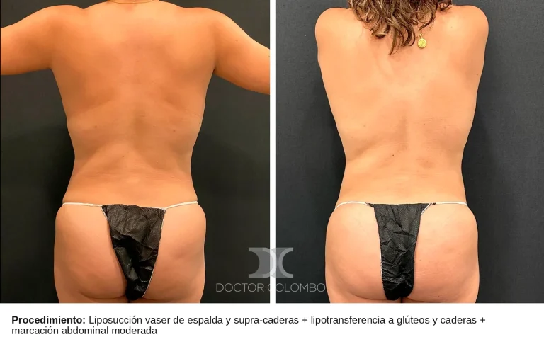 Antes y después de Gluteoplastia