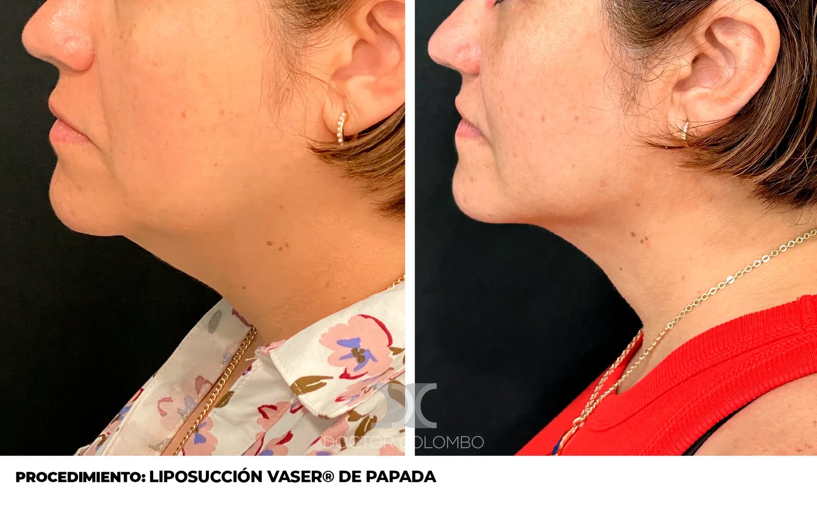 Liposucción de papada - antes y después, vista frontal