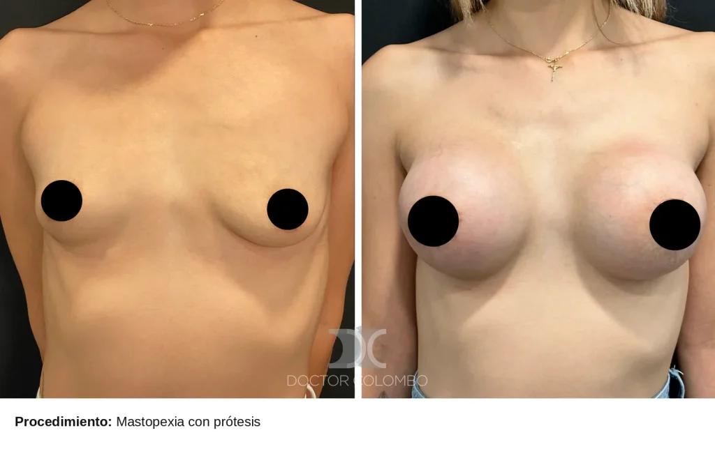 MASTO CON PROTESIS — Perfil derecho