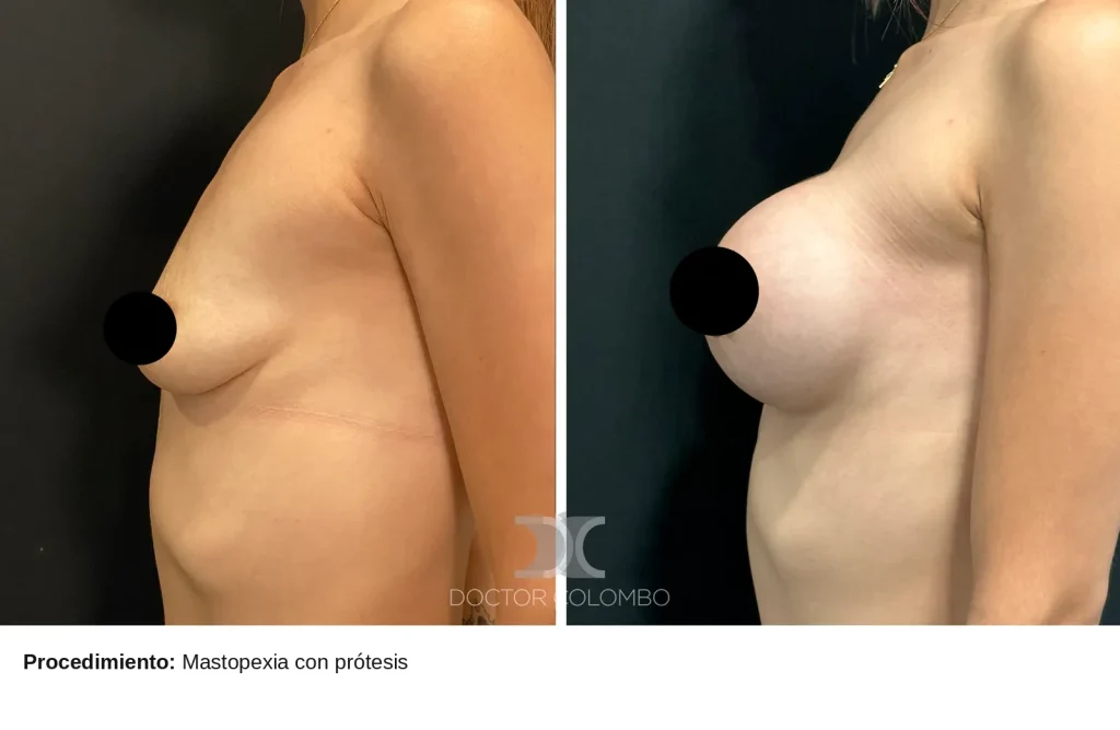MASTO CON PROTESIS — Perfil izquierdo