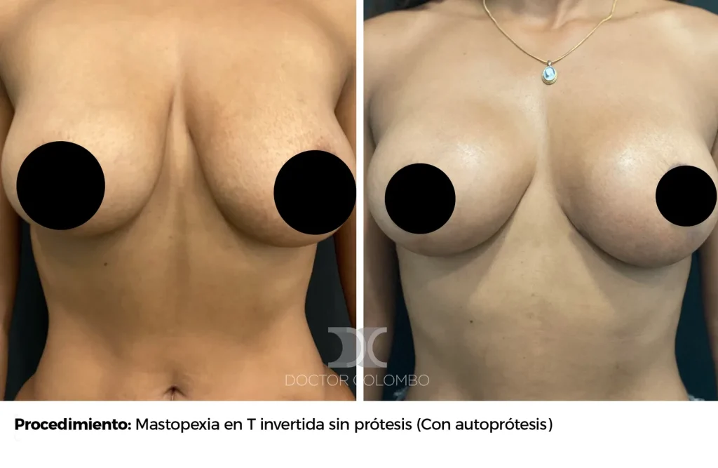 MASTOPEXIA EN T INVERTIDA SIN  PROTESIS – SIN NOCHE DE HOSPITALIZACIÓN — Frontal