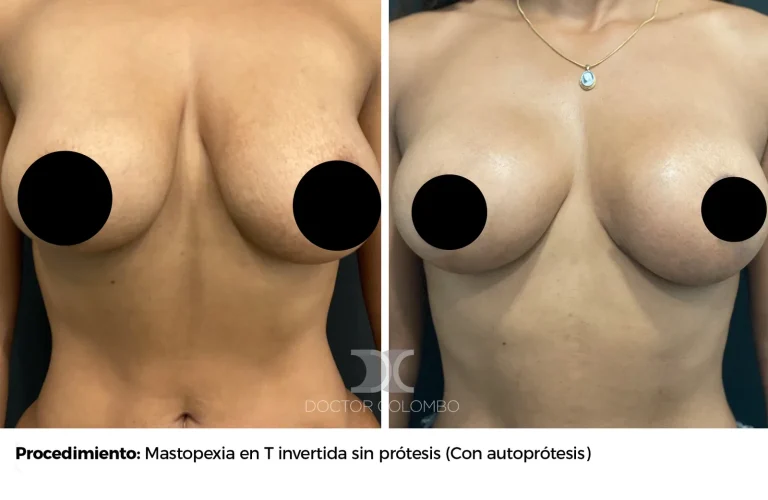 Antes y después de Mastopexia