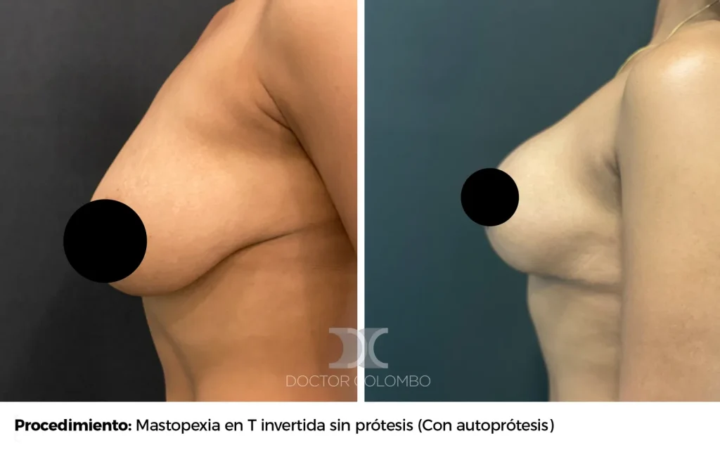 MASTOPEXIA EN T INVERTIDA SIN  PROTESIS – SIN NOCHE DE HOSPITALIZACIÓN — Perfil izquierdo