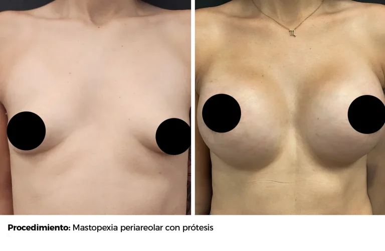 Antes y después de Mastopexia