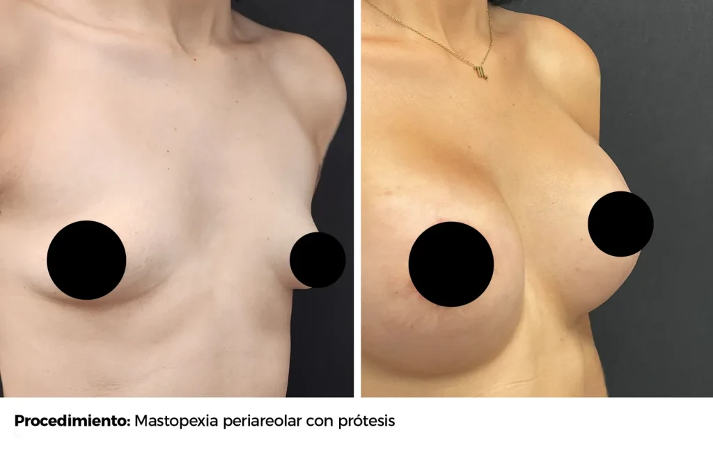 MASTOPEXIA PERIAREOLAR CON PROTESIS — Perfil derecho