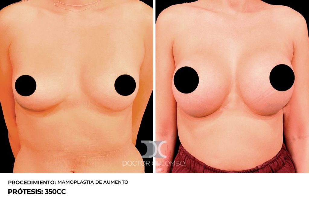 MAMOPLASTIA DE AUMENTO — Perfil derecho