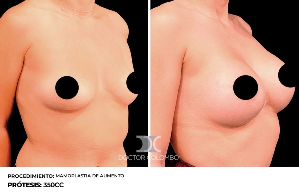 MAMOPLASTIA DE AUMENTO — Perfil izquierdo