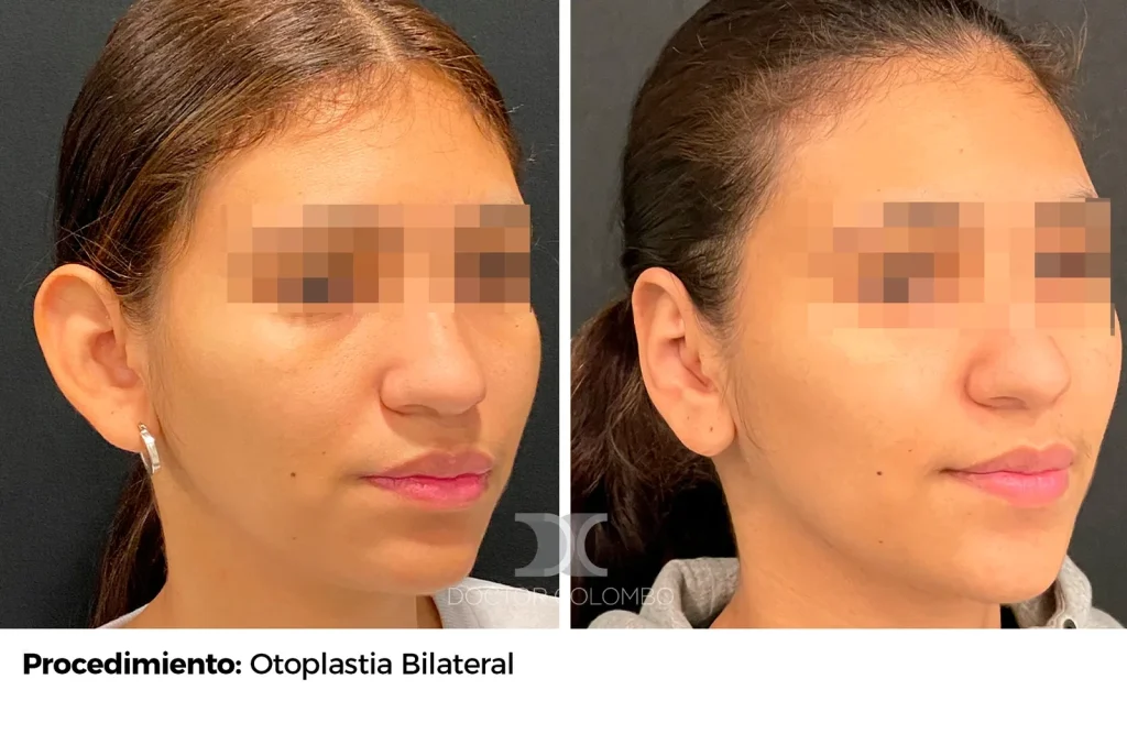 OTOPLASTIA CON RESECCIÓN DE CONCHA AURICULAR  – CON ANESTESIA LOCAL – AMBULATORIO — Perfil derecho