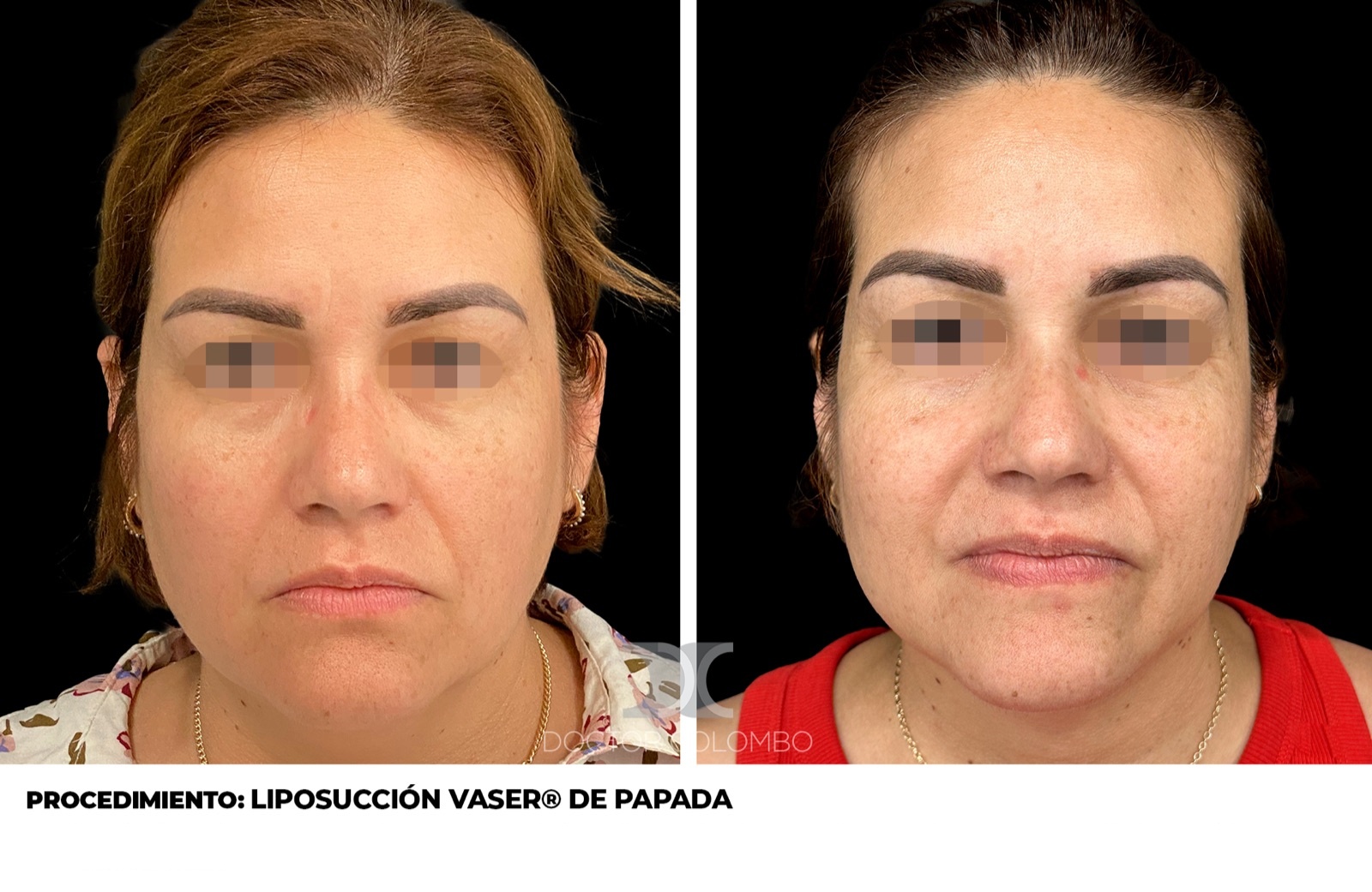 Liposucción de papada - antes y después, vista frontal