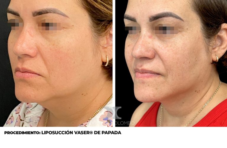 Antes y después de Liposucción de papada