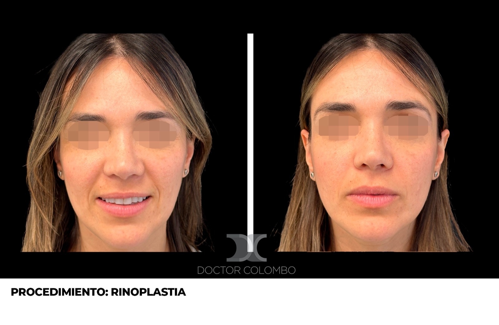 Rinoplastia de punta - antes y después, vista frontal
