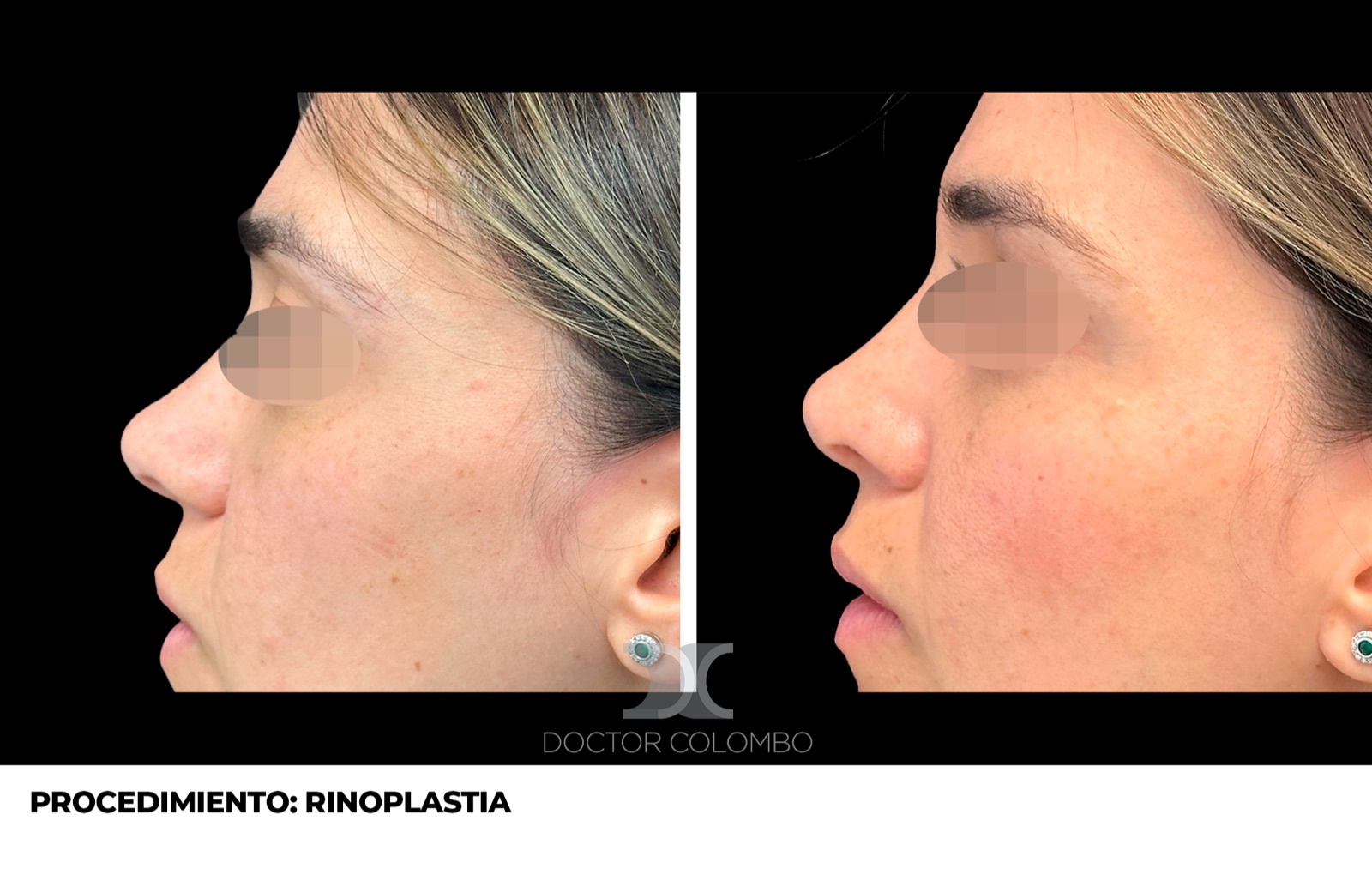 Rinoplastia de punta - antes y después, vista de perfil