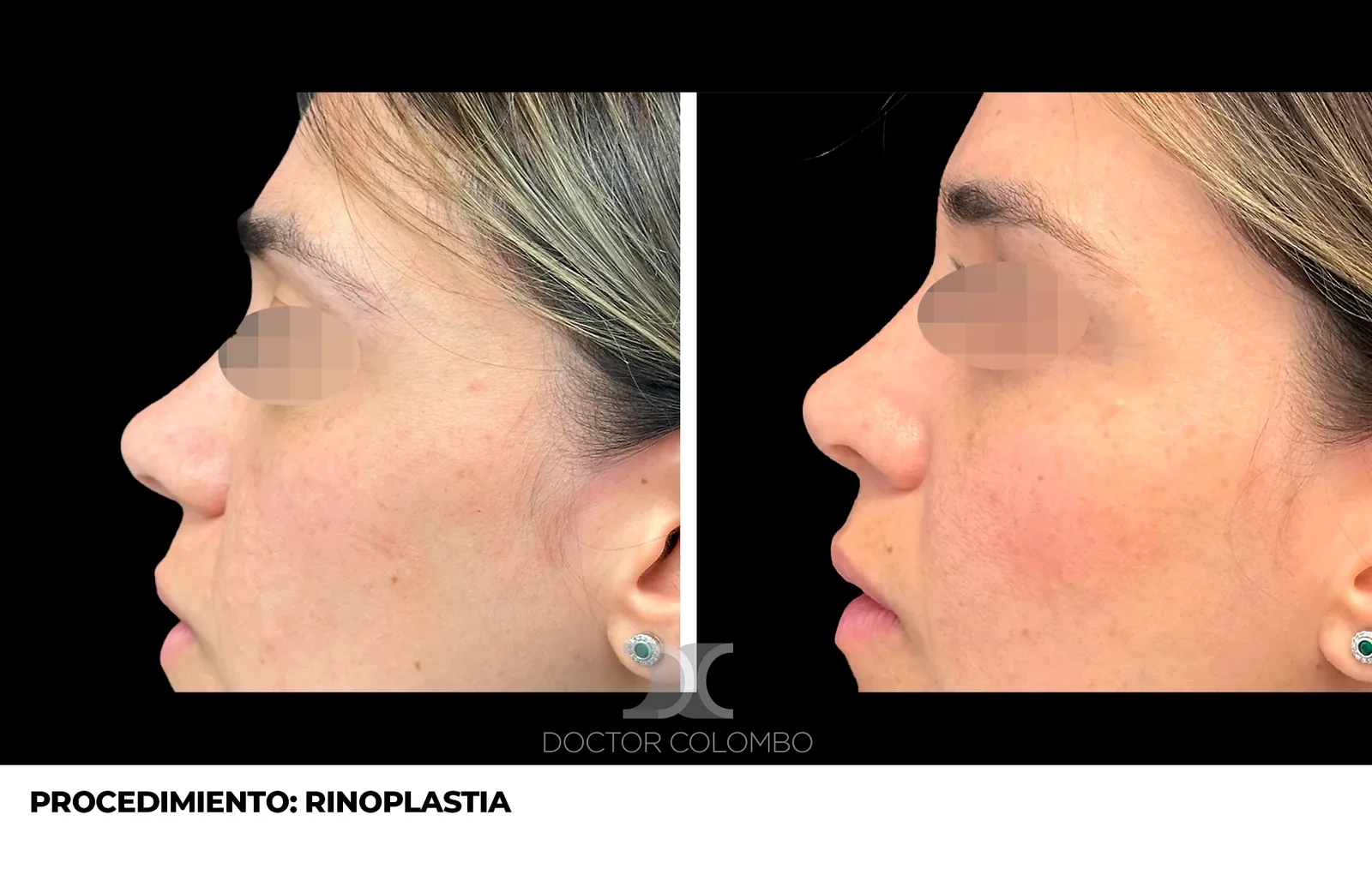 Resultado de rinoplastia de punta - antes y después, vista frontal