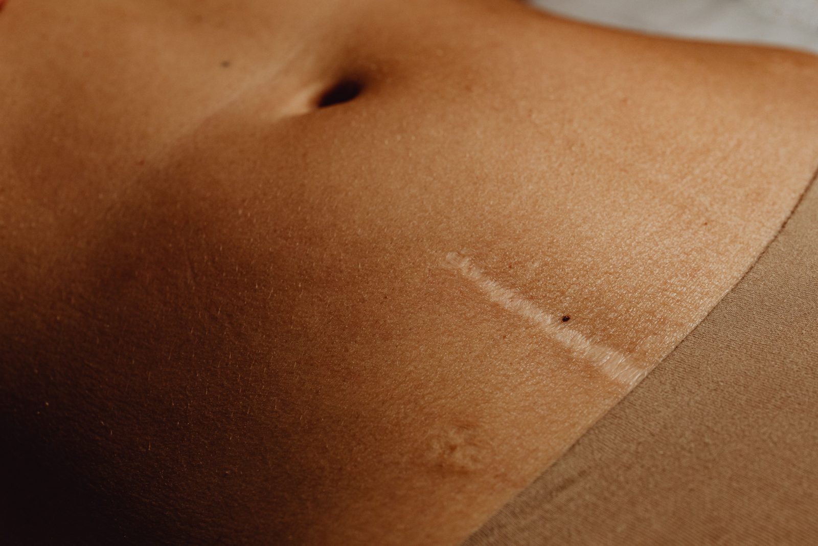 Primer plano del abdomen de una mujer con una cicatriz fina ya curada en el vientre bajo